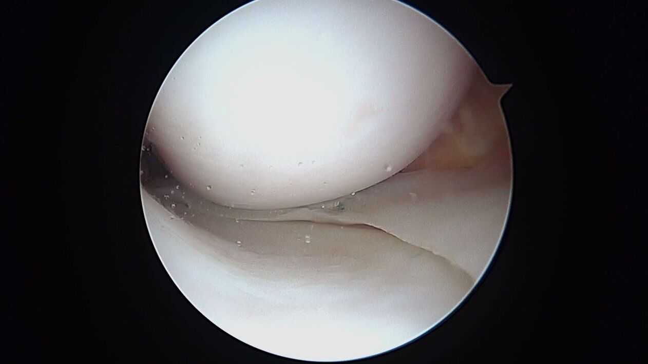 vue de l'articulation du genou à travers l'arthroscope
