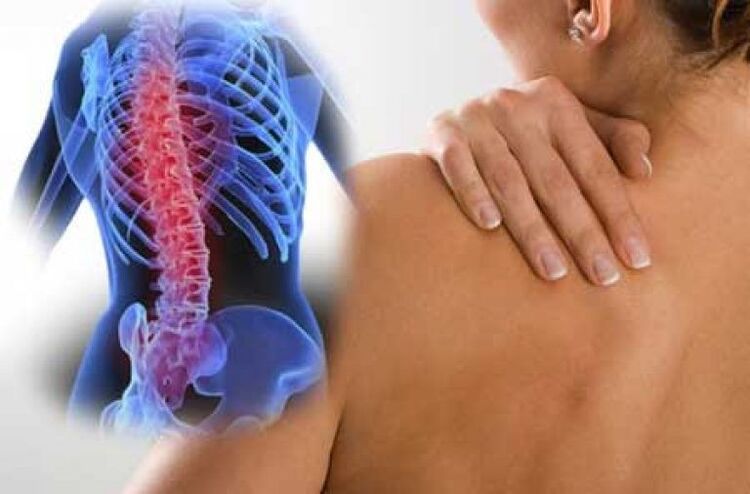 Avec l'ostéochondrose, la douleur peut irradier vers des parties éloignées du corps. 