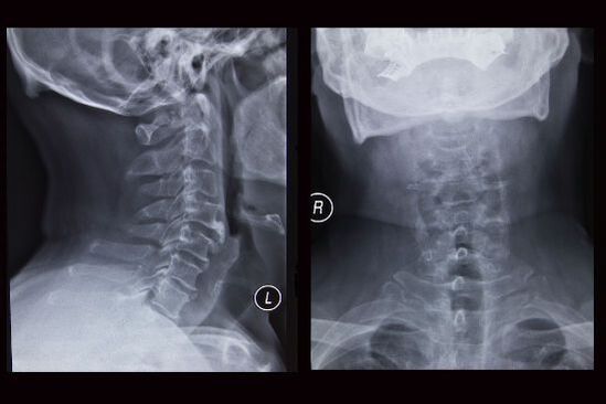 Image radiographique de la colonne cervicale (le patient souffre d'ostéochondrose)