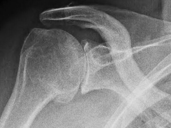 Radiographie d'une articulation de l'épaule affectée par l'arthrose. 