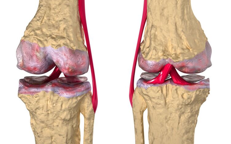 Traitement de l'arthrose