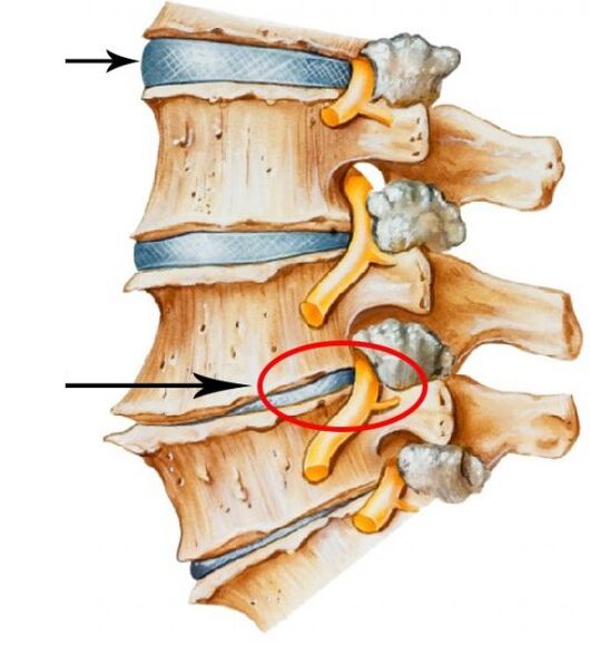 Ostéochondrose cervicale