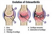 Étapes de l'arthrose