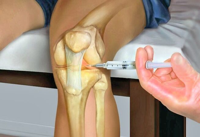 Traitement de l'arthrose articulaire du genou