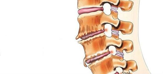 Destruction de la spondylose des articulations intervertébrales