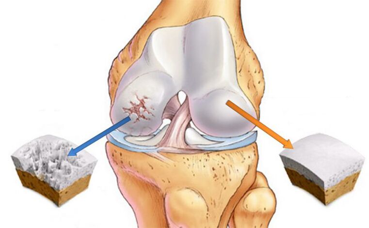 déformation de l'arthrose