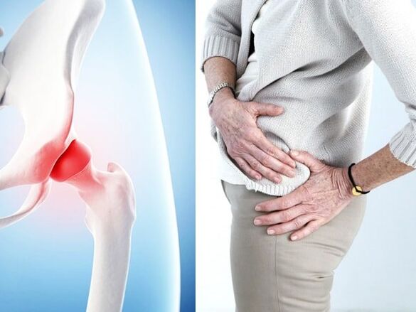 Symptômes de l'arthrohrose de l'articulation de la hanche