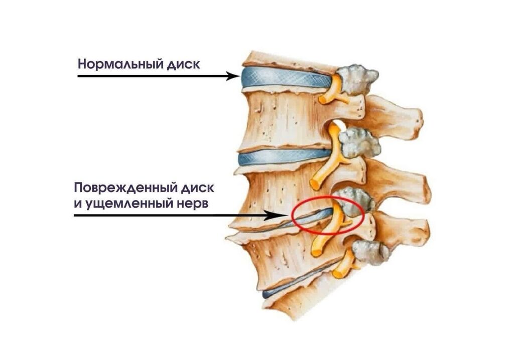 Symptômes de l'ostéochondrose cervicale.