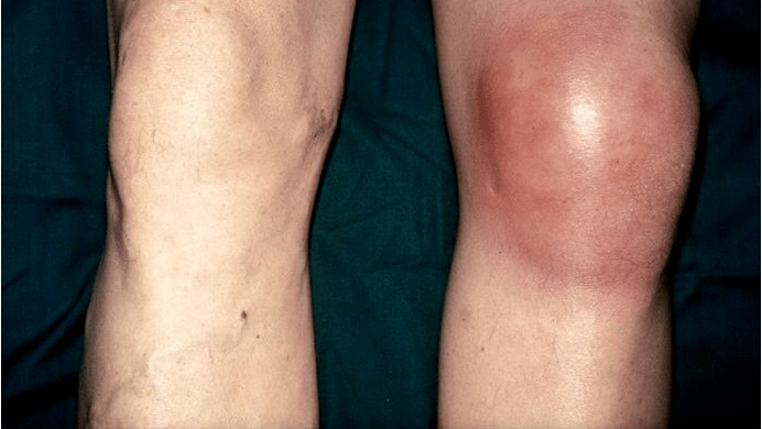 arthrose et arthrite