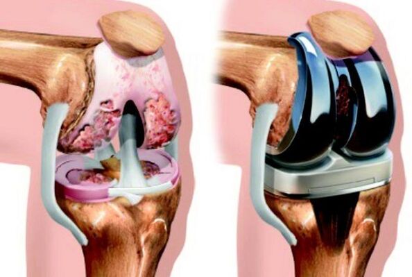avant et après une arthrose de l'articulation du genou due à une arthrose